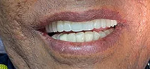 Laurel Bowie Implant and Cosmetic Dentistry | Dentures, All-on-X and Ceramic Crowns