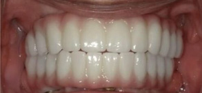 Laurel Bowie Implant and Cosmetic Dentistry | Veneers, Implant Dentistry and Invisalign reg 