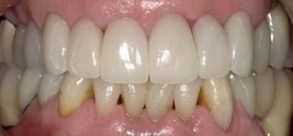 Laurel Bowie Implant and Cosmetic Dentistry | Implant Restorations, Night Guards and Oral Cancer Screening