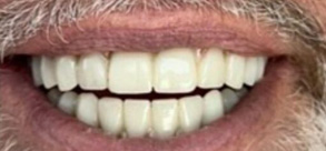 Laurel Bowie Implant and Cosmetic Dentistry | Ceramic Crowns, Extractions and Dental Cleanings