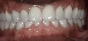 Laurel Bowie Implant and Cosmetic Dentistry | Oral Exams, Teeth Whitening and All-on-X