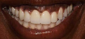 Laurel Bowie Implant and Cosmetic Dentistry | Dental Fillings, Dental Bridges and Laser Dentistry