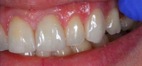 Laurel Bowie Implant and Cosmetic Dentistry | Oral Exams, Dentures and Oral Cancer Screening