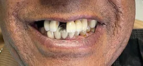 Laurel Bowie Implant and Cosmetic Dentistry | Root Canals, Dental Cleanings and Cosmetic Dentistry