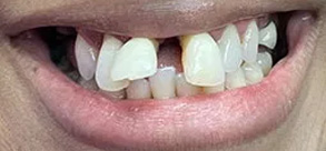 Laurel Bowie Implant and Cosmetic Dentistry | Ceramic Crowns, Dental Fillings and Dentures