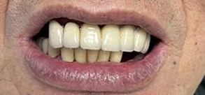 Laurel Bowie Implant and Cosmetic Dentistry | Dental Bridges, Periodontal Treatment and Implant Dentistry