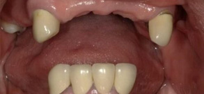 Laurel Bowie Implant and Cosmetic Dentistry | Night Guards, Implant Restorations and Root Canals