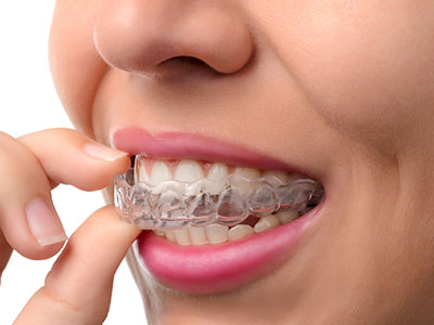 Laurel Bowie Implant and Cosmetic Dentistry | Extractions, Invisalign reg  and Cosmetic Dentistry