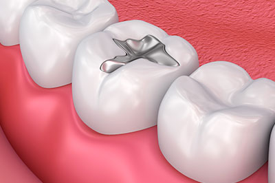 Laurel Bowie Implant and Cosmetic Dentistry | Extractions, Dentures and Cosmetic Dentistry
