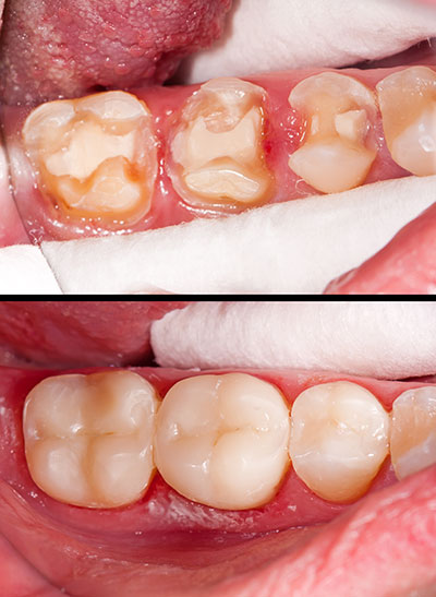 Laurel Bowie Implant and Cosmetic Dentistry | Night Guards, Dentures and Emergency Treatment