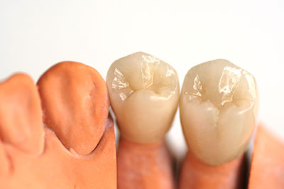 Laurel Bowie Implant and Cosmetic Dentistry | Dental Fillings, Laser Dentistry and Teeth Whitening