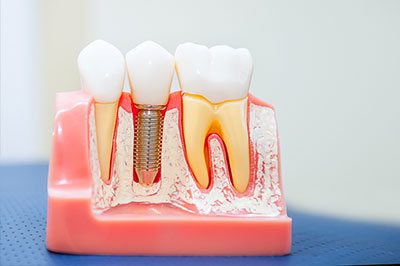 Laurel Bowie Implant and Cosmetic Dentistry | Emergency Treatment, Night Guards and Extractions