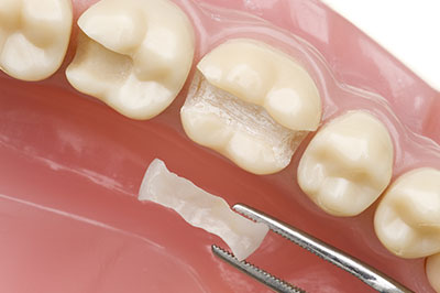 Laurel Bowie Implant and Cosmetic Dentistry | Ceramic Crowns, Dental Bridges and Veneers