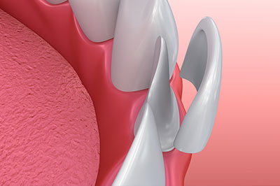 Laurel Bowie Implant and Cosmetic Dentistry | Oral Cancer Screening, Root Canals and Dental Cleanings