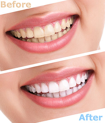 Laurel Bowie Implant and Cosmetic Dentistry | Preventative Program, All-on-X and Veneers