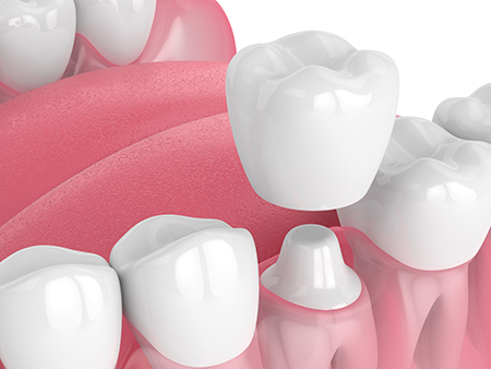Laurel Bowie Implant and Cosmetic Dentistry